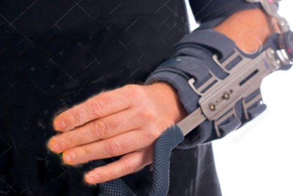 broken arm in cast