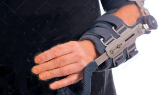 broken arm in cast